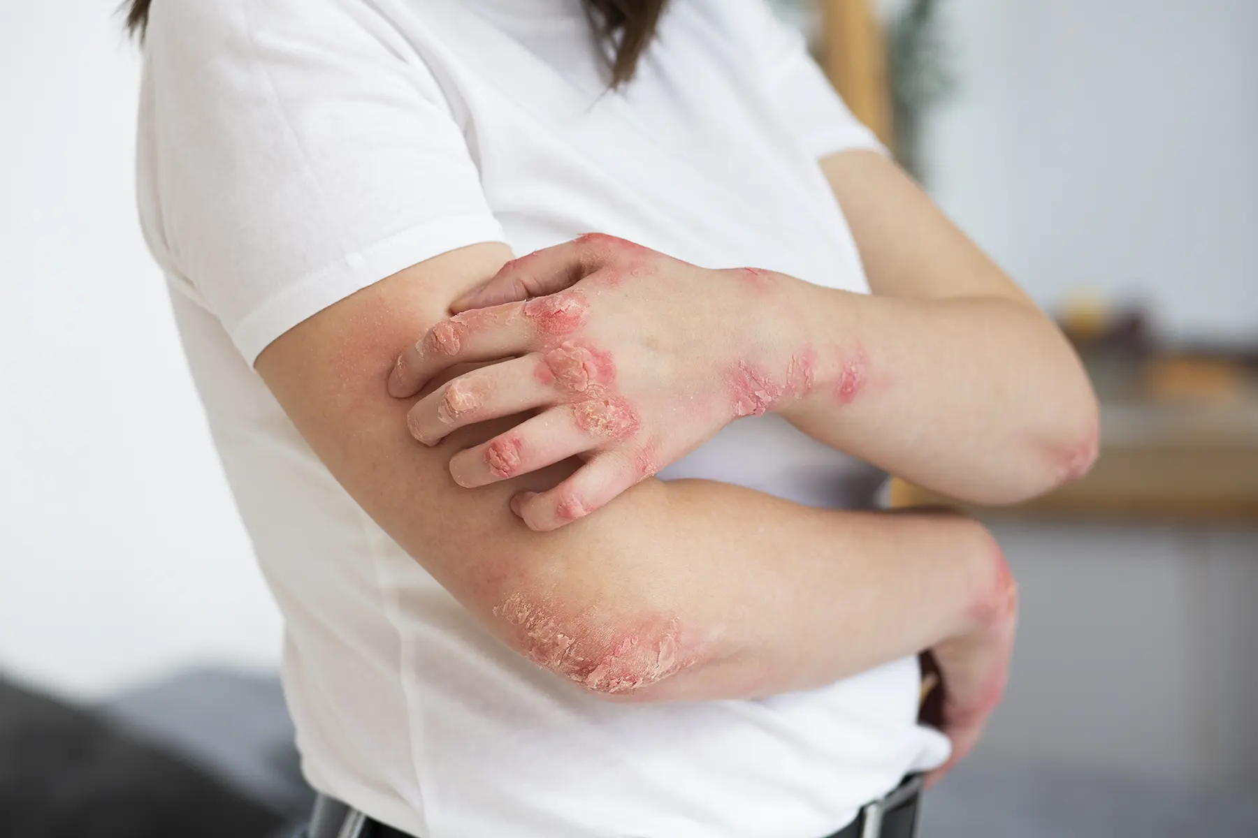 Dermatita atopica (eczema) – cauze, simptome, tratament